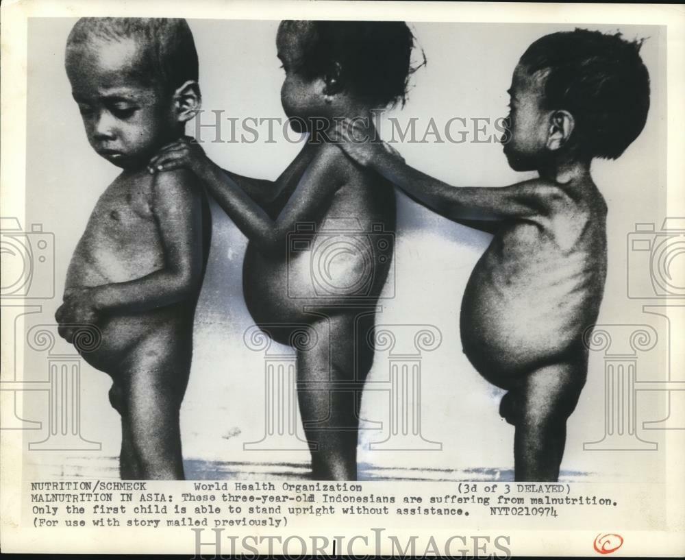 1974 Press Photo Three-year-old Indonesians are suffering from malnutrition