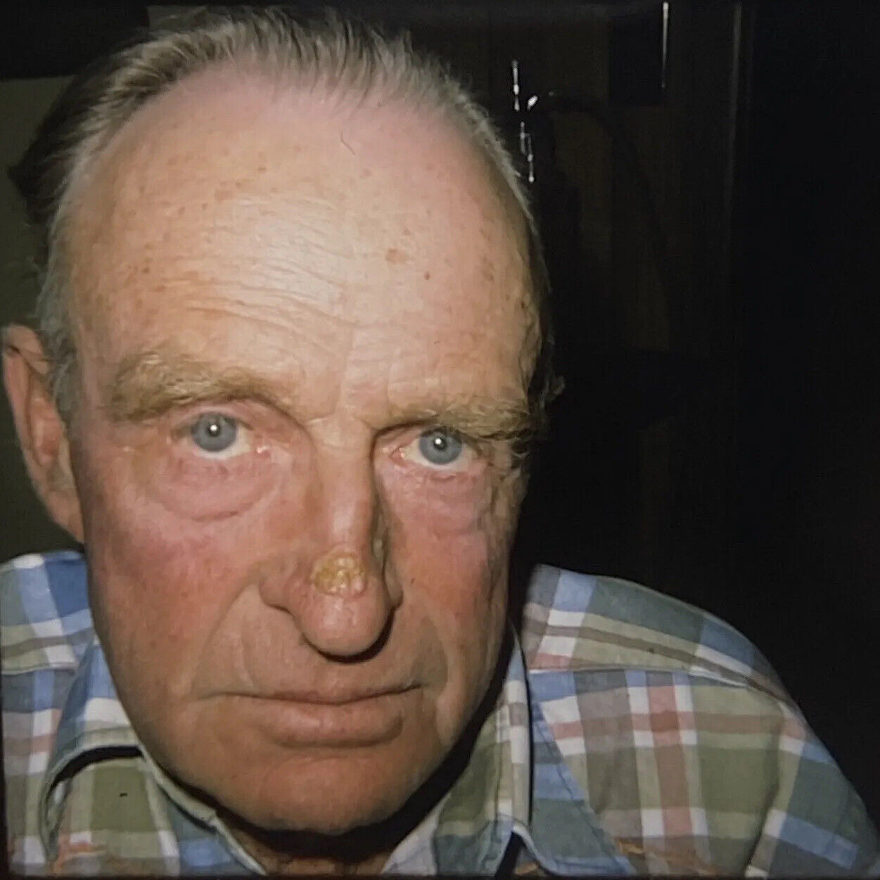 Vintage Photo Slide 1975 Man Nose Pre Surgery