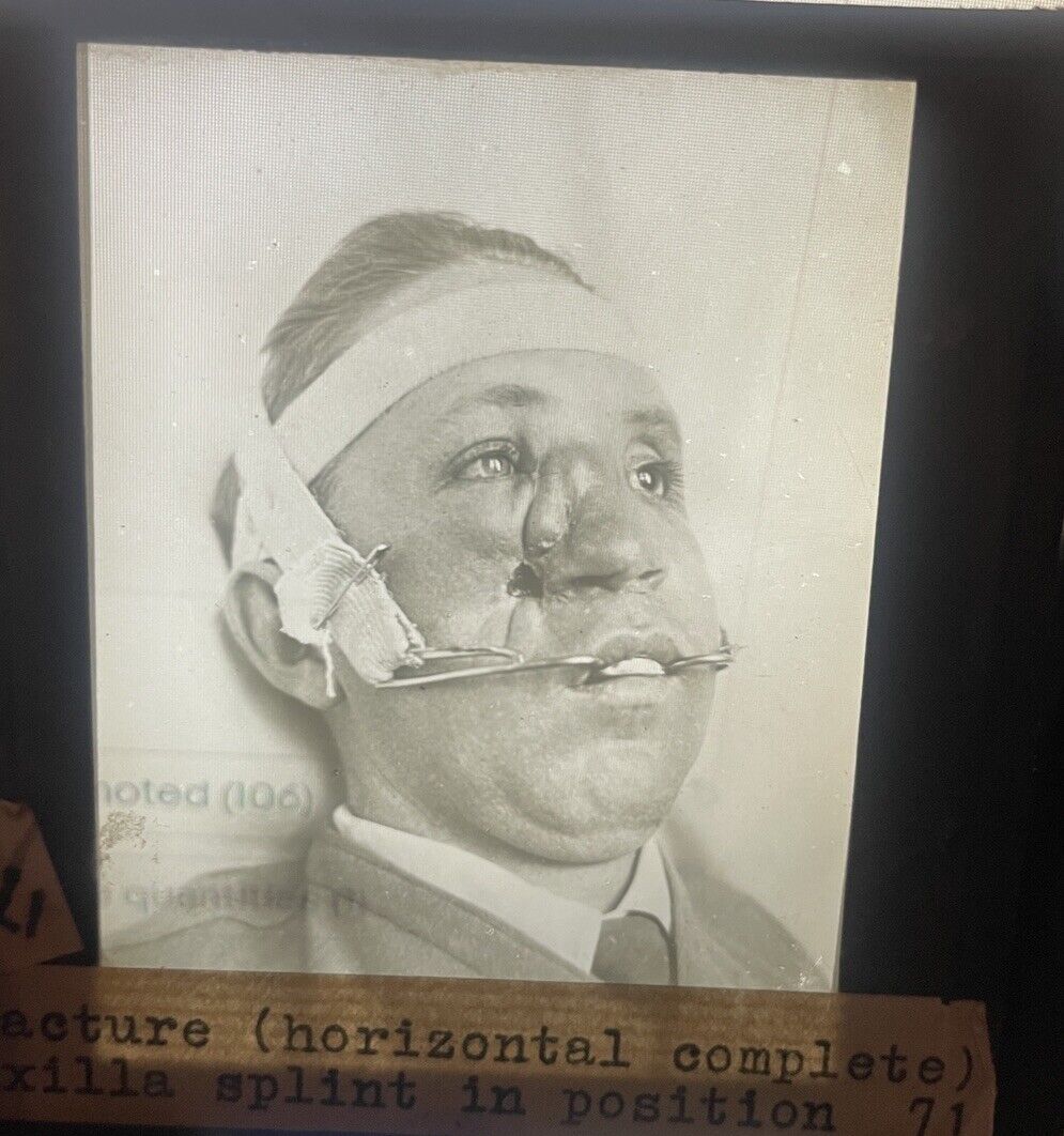 Antique Medical GLASS SLIDE Photo PLASTIC SURGERY Splint Face Nose Procedure #10
