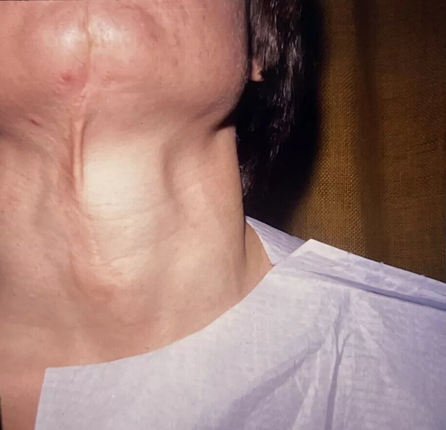 Vintage Photo Slide 1978 Woman Neck Surgery Scar