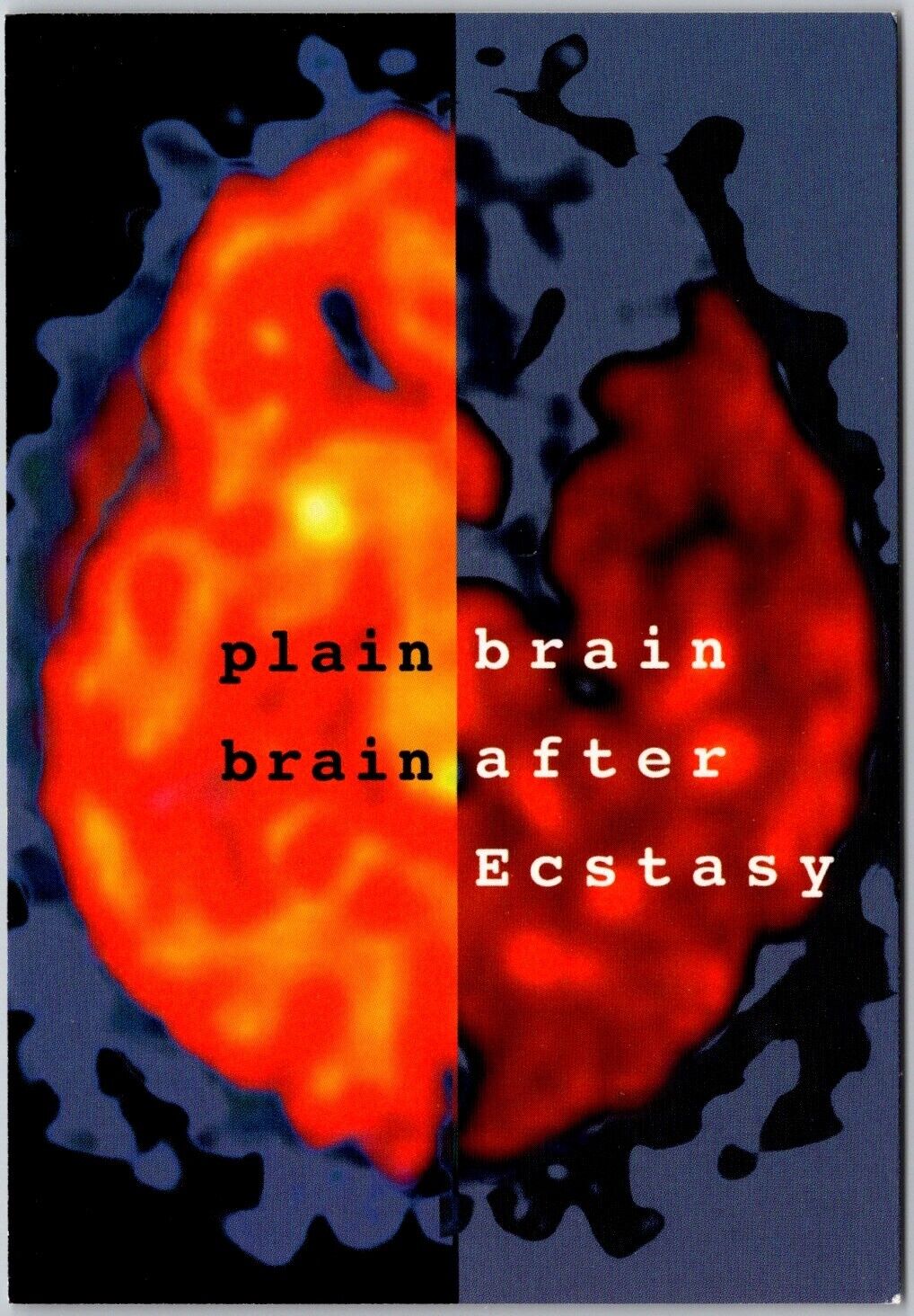 Postcard: Brain Scans - Effects of Ecstasy (XTC, MDMA) Drug Abuse on Seroto A168