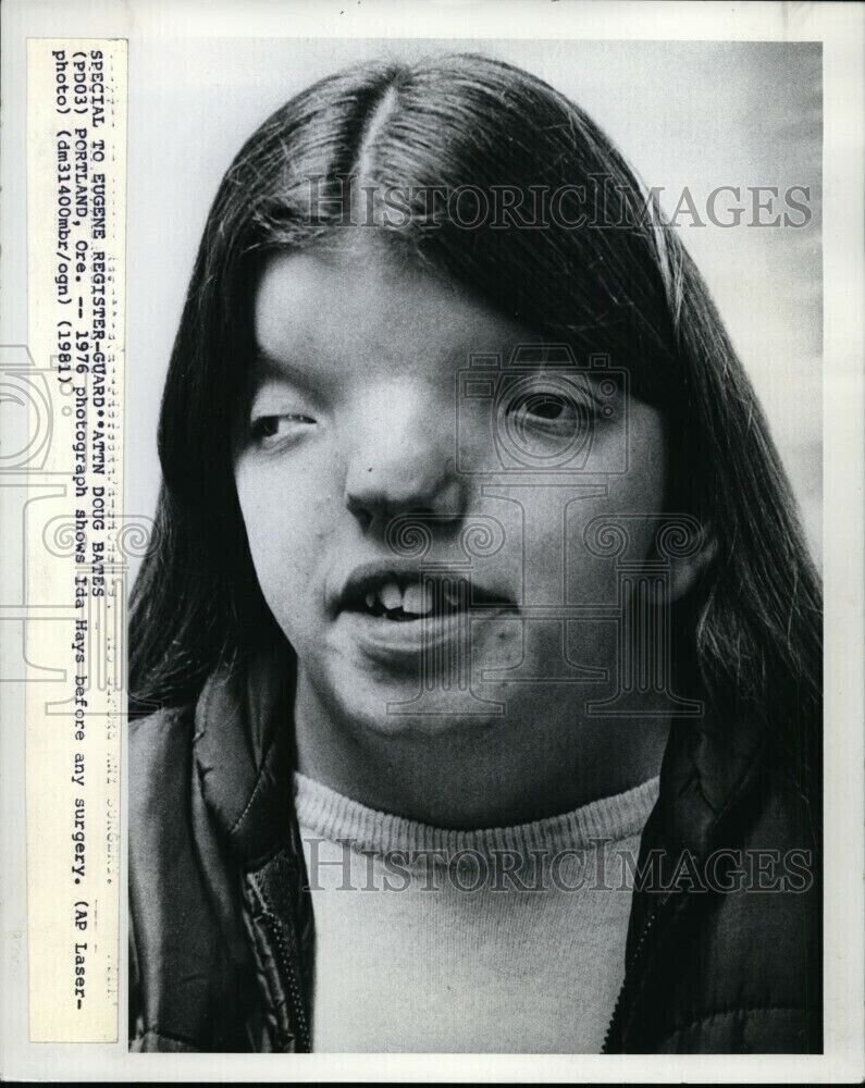 1981 Wirephoto 1976 shows Ida Hays before any surgery - orw08084 10.25X8 Photo