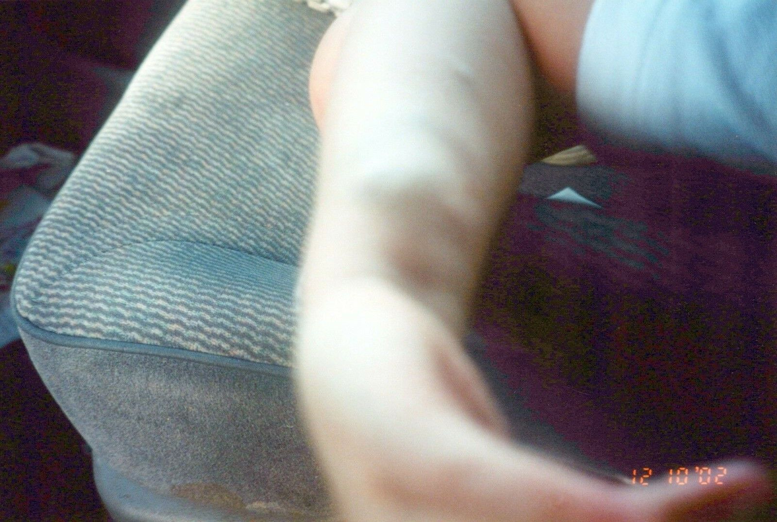 2000's Found Photo - Strange Weird Odd Picture Of Kids Arm With A Rash Disease