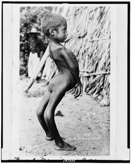Mexican boy,birth defects,children,handicapped persons,skeleton,knees,c1915