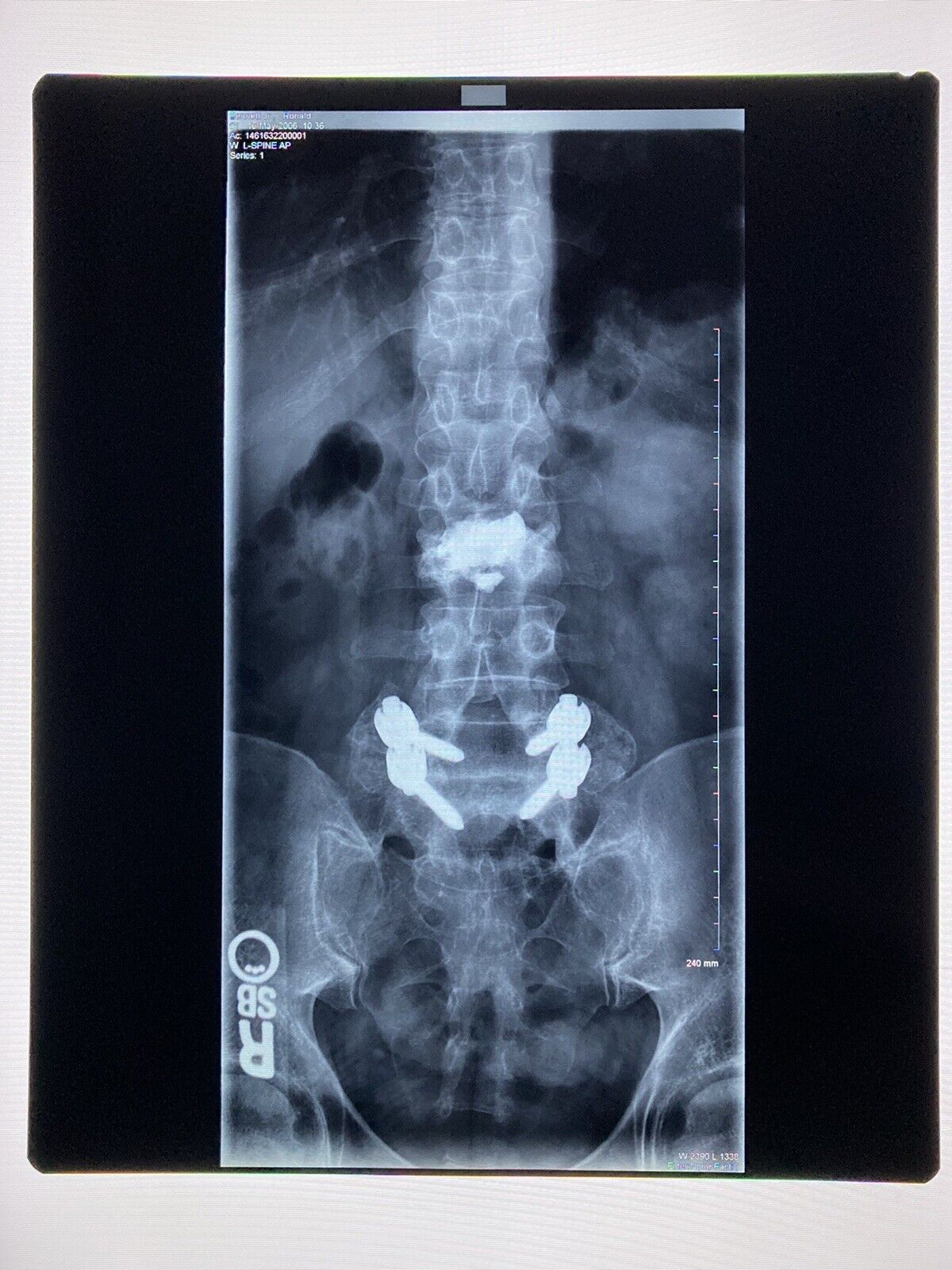 Xray film, x-ray, Used, Oddity, Medical, Surgical, Funeral - 14 x 17 MRI - SPINE