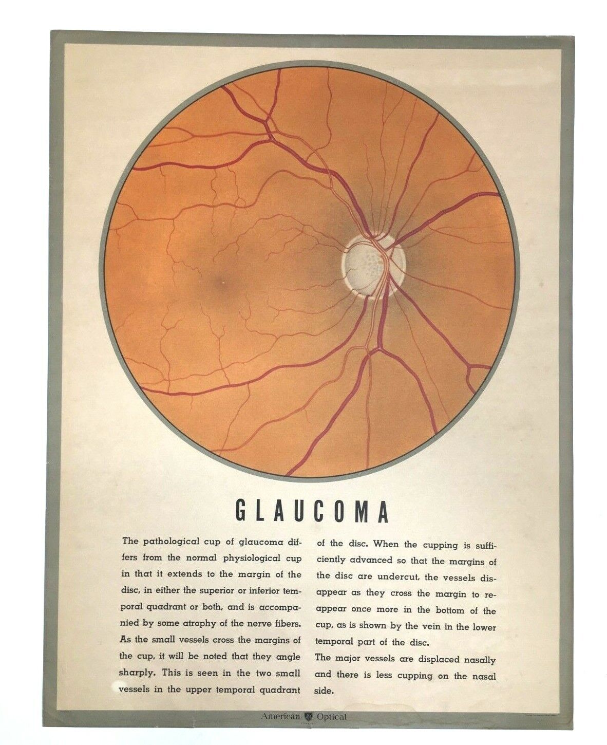 Vintage American Optical Medical Poster Diseases of The Human Eye Glaucoma 1943