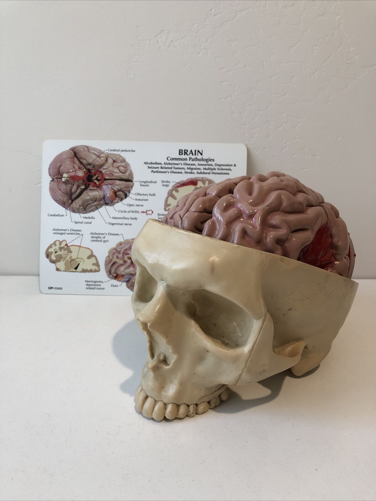 GPI Brain Anatomical Model #2900 Diseased Brain In Skull Missing CircleOfWillis