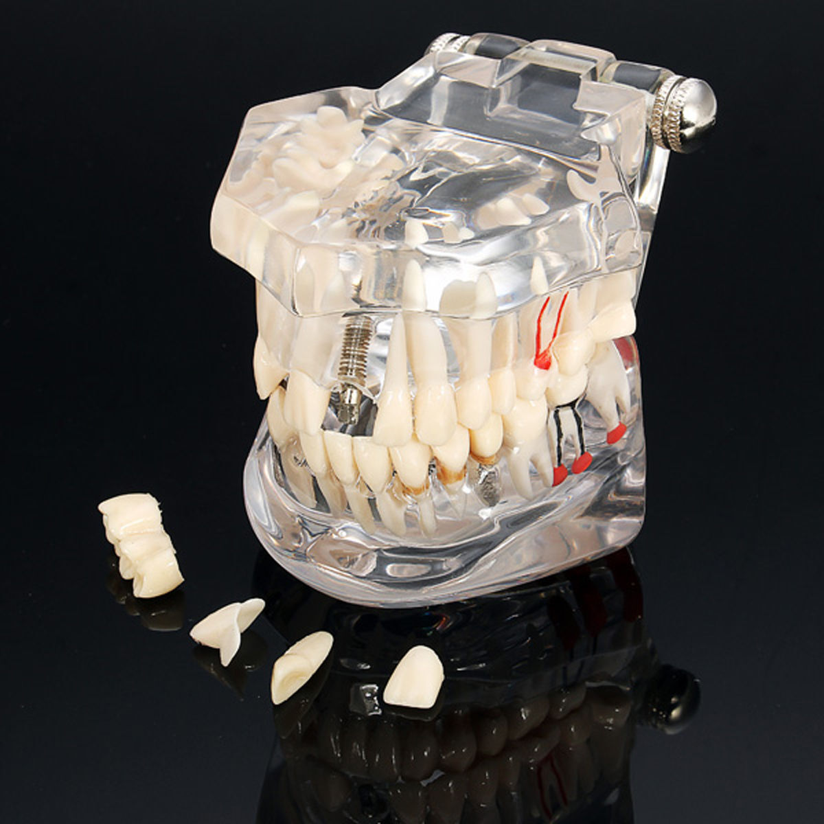 Removable Dental Implant Disease Study Teeth Model Restoration & Bridge Tooth