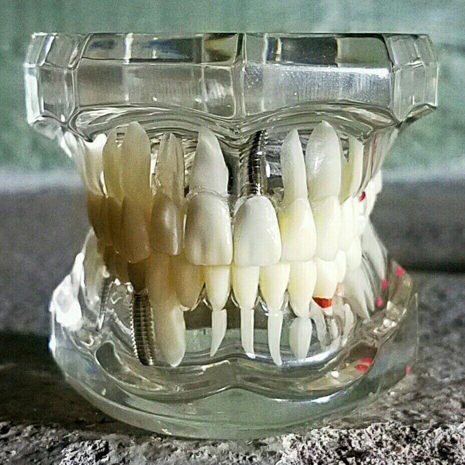 Disease Teeth Model, Clear Dental Teeth Model, Vintage Medical, Oddities, Weird