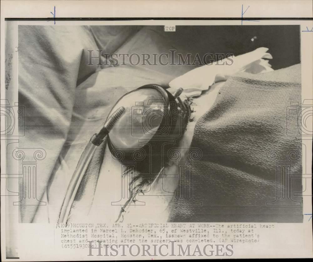 1966 Press Photo Artificial heart affixed to patient's chest in Houston hospital