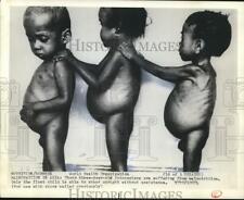 1974 Press Photo Three-year-old Indonesians are suffering from malnutrition picture