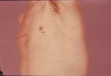 Vintage Photo Slide 1970s Mans Armpit Chest Surgery Scar picture