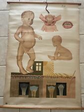 Original vintage medical pull down school chart of Rachitis of child picture