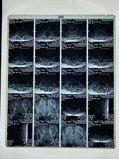 Xray film, x-ray, Used, Oddity, Medical, Surgical, Funeral - 14 x 17 MRI - SPINE picture