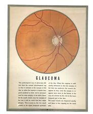 Vintage American Optical Medical Poster Diseases of The Human Eye Glaucoma 1943 picture