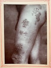 1908 Mounted Photo Skin Disease On Man’s Thigh Syphilis? picture