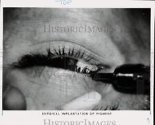 1985 Press Photo Patient's eye during surgical pigment implantation procedure picture