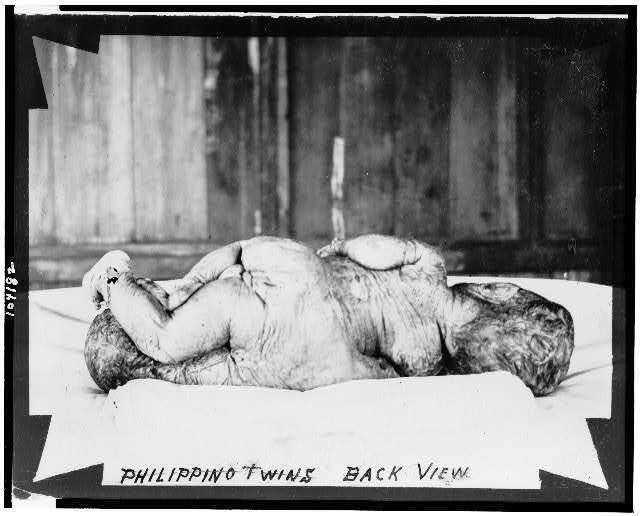 Philippino twins,back view,Siamese,conjoined,birth defects,handicapped,c1903