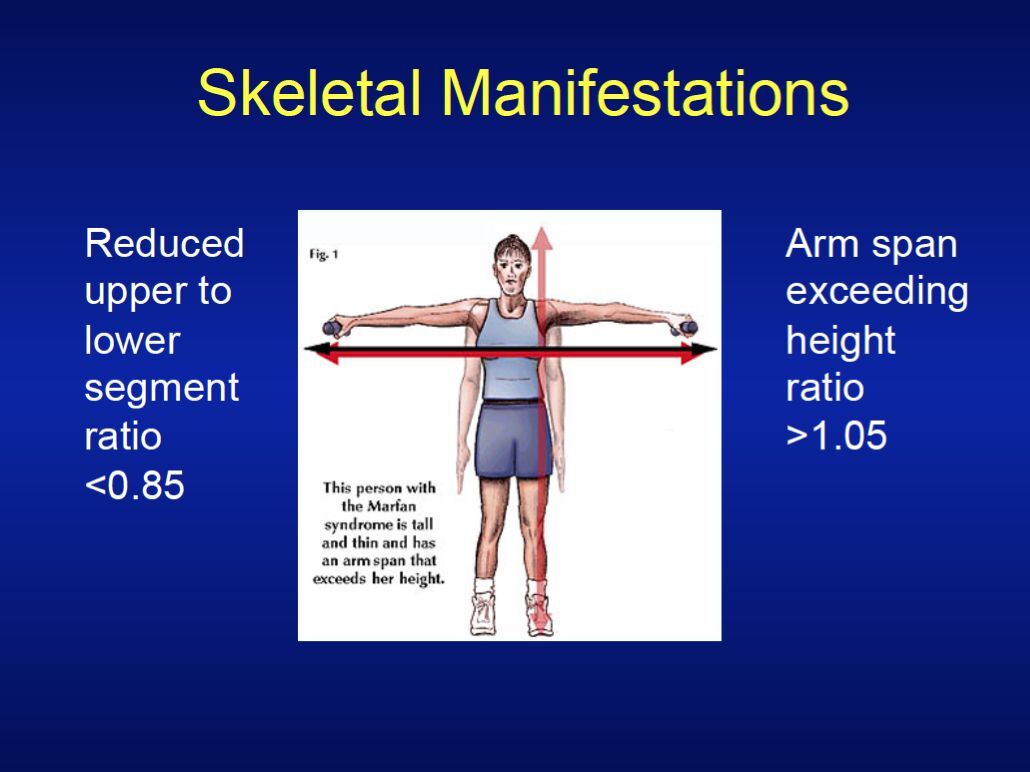 218 slide Skeletal Bone Genetics MARFAN SYNDROME PowerPoint Presentation on CD 