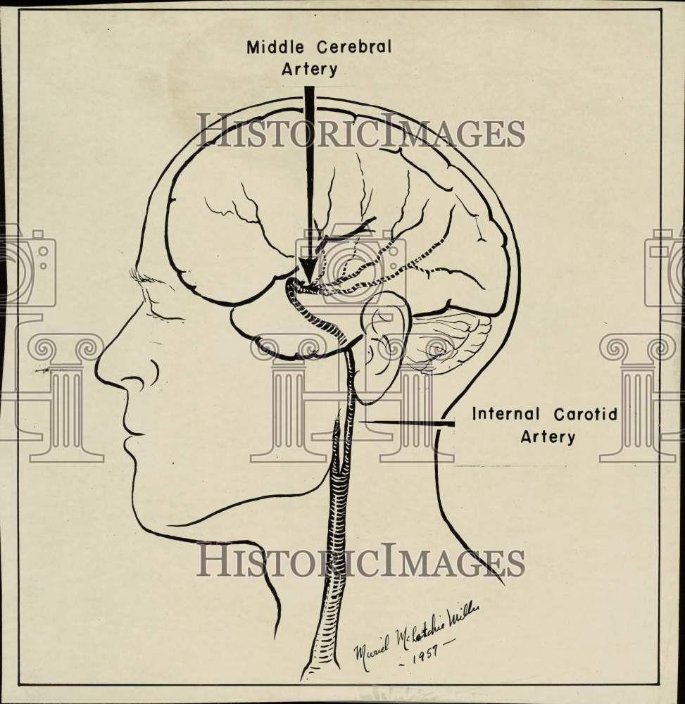 1957 Press Photo Brain sketch shows location of the President\'s ailment