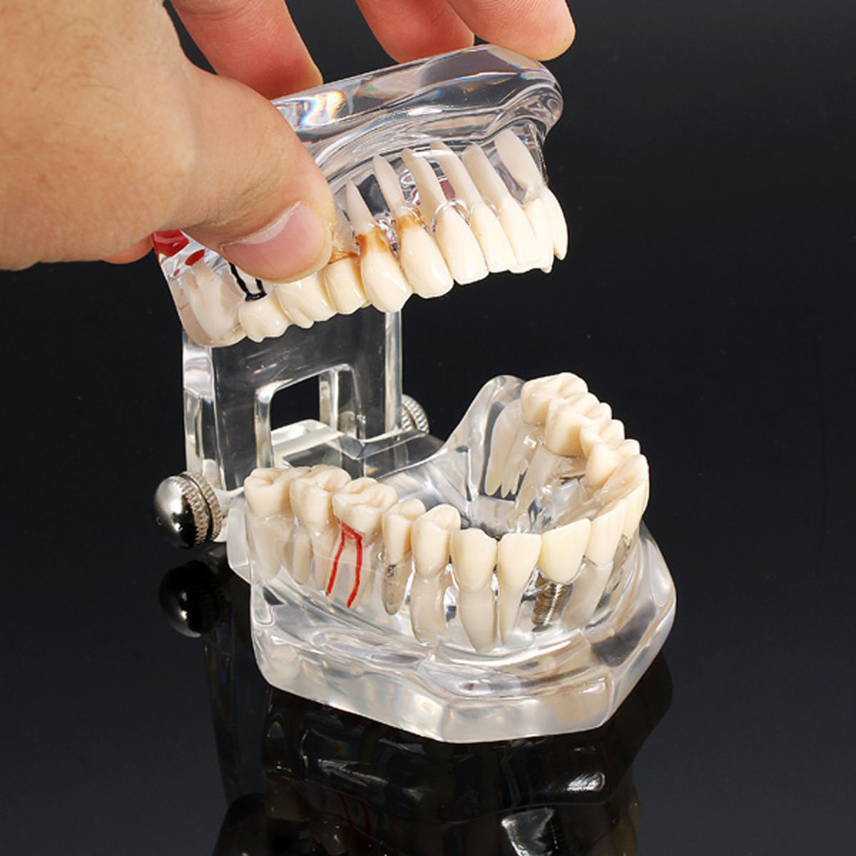 Dental Implant Disease Study Teachin Teeth Model With Restoration & Bridge Tooth
