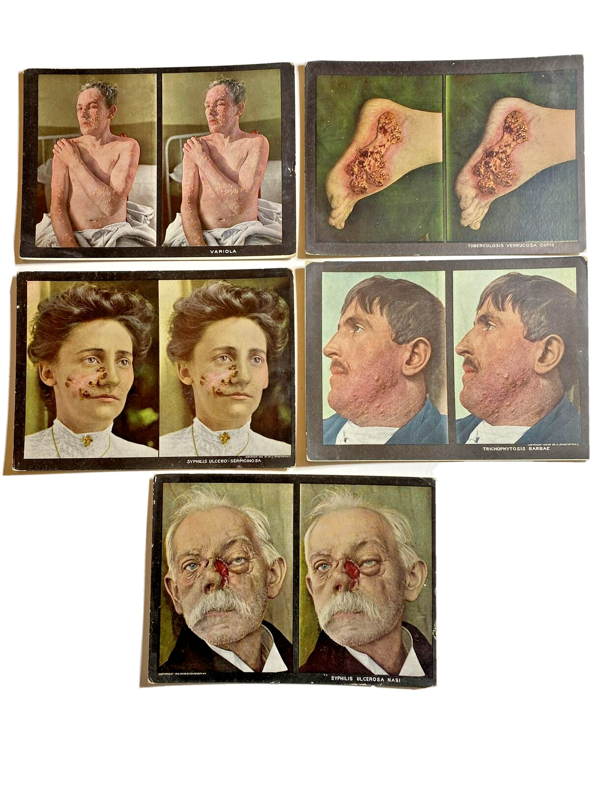 1910 Stereoscopic Skin Disease Clinic Cards Dr Rainforth NY-Macabre Set 115/128
