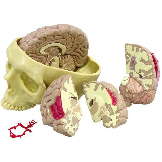 Brain Diseased Anatomical Model   GPI  LFA #2900 SEE VIDEO