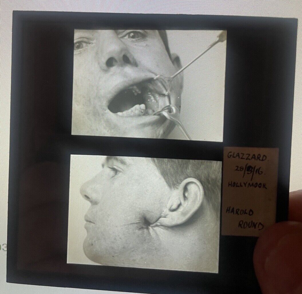 Antique 1916 Medical GLASS SLIDE Photo PLASTIC SURGERY Gunshot  Face  Repair #08