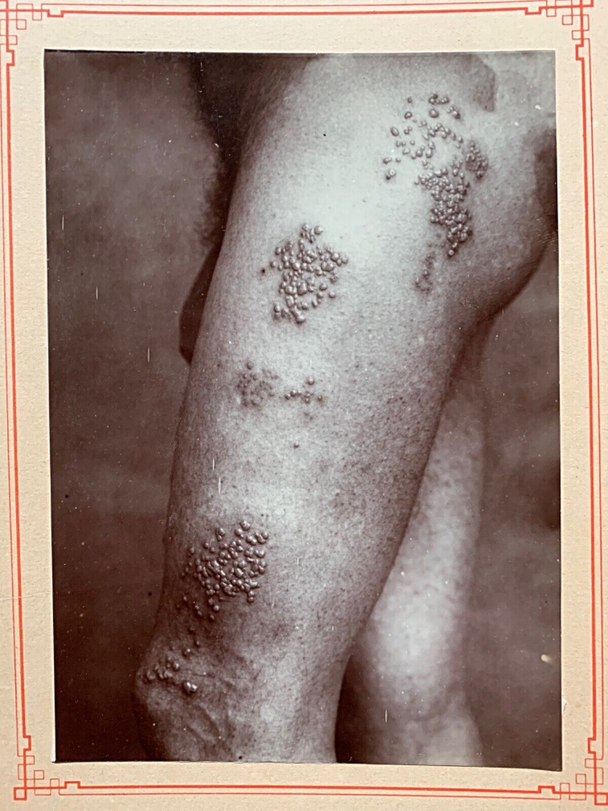 1908 Mounted Photo Skin Disease On Man’s Thigh Syphilis?