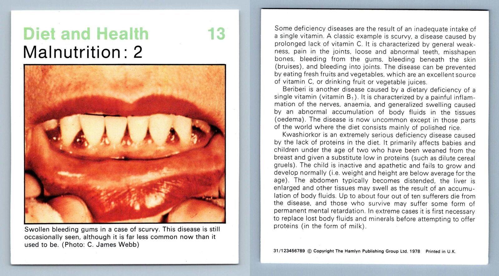 Malnutrition #13 Diet & Health - Home Medical Guide 1975-8 Hamlyn Card