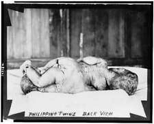 Philippino twins,back view,Siamese,conjoined,birth defects,handicapped,c1903 picture