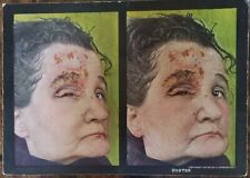 Rare 1910 MEDICAL SKIN DISEASE STEREOVIEW CARD-HERPES - ZOSTER picture