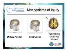 42 page TRAUMATIC BRAIN INJURY Primer PowerPoint Presentation on CD picture