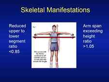 218 slide Skeletal Bone Genetics MARFAN SYNDROME PowerPoint Presentation on CD  picture