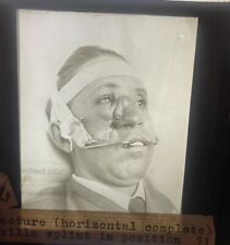 Antique Medical GLASS SLIDE Photo PLASTIC SURGERY Splint Face Nose Procedure #10 picture