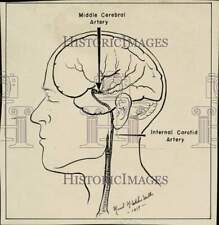 1957 Press Photo Brain sketch shows location of the President's ailment picture