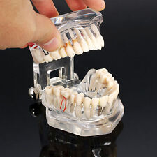 Dental Implant Disease Study Teachin Teeth Model With Restoration & Bridge Tooth picture