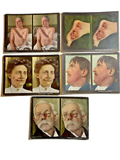 1910 Stereoscopic Skin Disease Clinic Cards Dr Rainforth NY-Macabre Set 115/128 picture