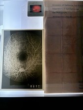 Ophthalmology Retina Eye Photography Slides Photos Neal White Archive UCSF picture