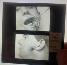 Antique 1916 Medical GLASS SLIDE Photo PLASTIC SURGERY Gunshot  Face  Repair #08 picture