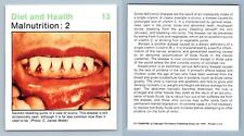 Malnutrition #13 Diet & Health - Home Medical Guide 1975-8 Hamlyn Card picture