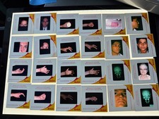 40 COSMETIC SURGERY MEDICAL WEIRD STRANGE VINTAGE 50s 60s COLOR SLIDES picture