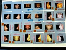 24 COSMETIC BREAST SURGERY MEDICAL SLIDES WEIRD STRANGE VINTAGE COLOR picture