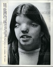1981 1976 Shows Ida Hays Before Any Surgery 10X8 Wirephoto picture
