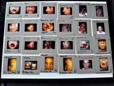 100 COSMETIC SURGERY MEDICAL WEIRD STRANGE VINTAGE COLOR SLIDES GUNSHOT DOG BITE picture